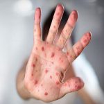 هشدار افزایش ابتلا به سرخک در رفسنجان؛ مرکز بهداشت: واکسن کودکان را جدی بگیرید